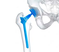 Total Knee Replacement physiotherapy Milton