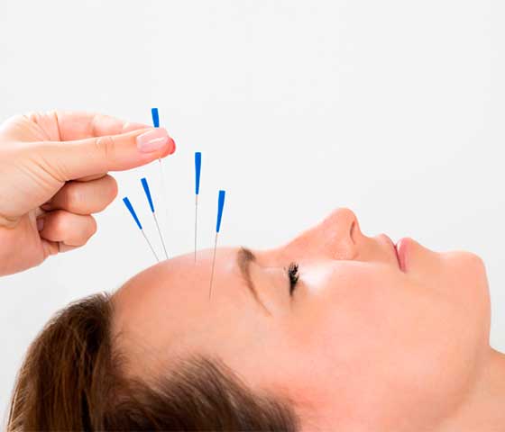 Headache Relief with acupuncture