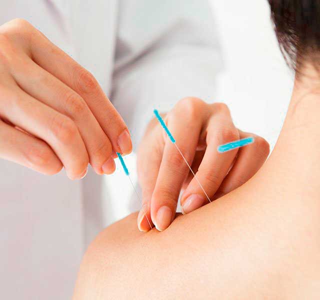 Acupuncture in Milton