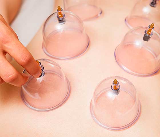 Cupping Techniques in Milton