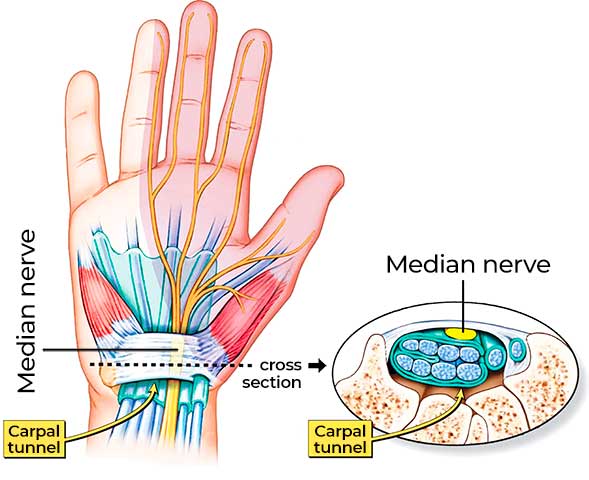 Carpal Tunnel Syndrome Treatment in Milton