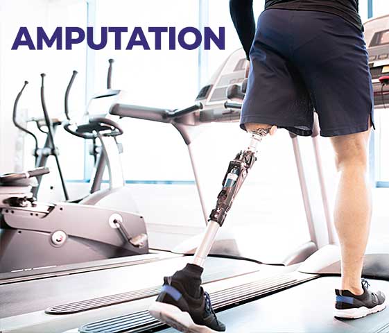 Amputation Recovery Physiotherapy in Milton