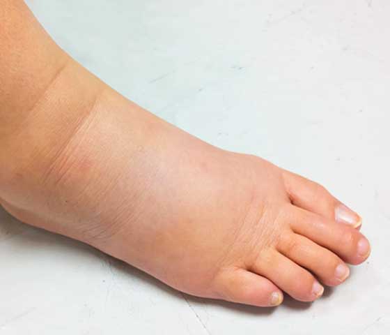 Lymphedema Therapy in Milton
