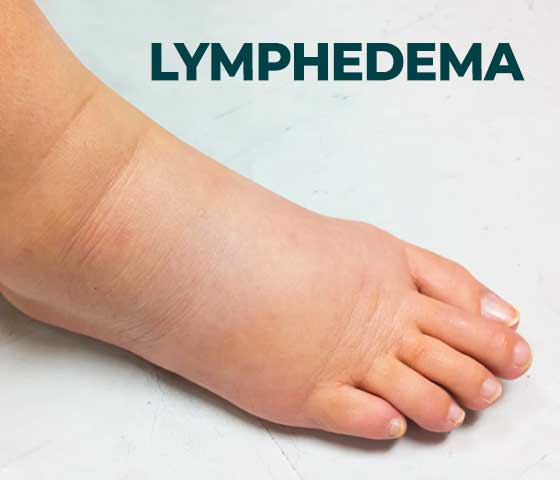 Lymphedema Therapy in Milton