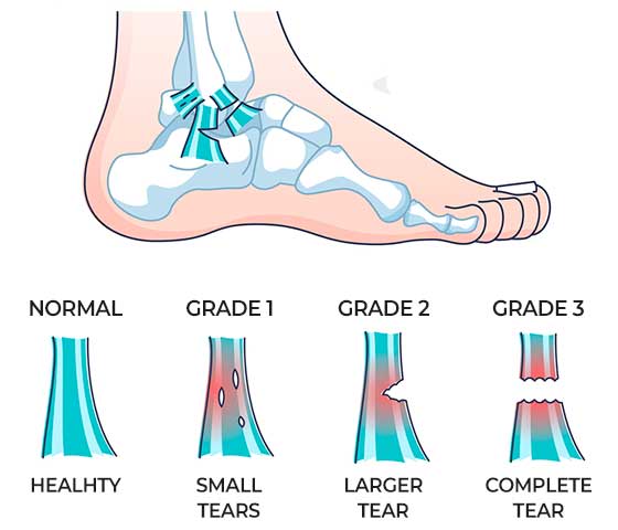 Ankle Sprain Physiotherapy in Milton