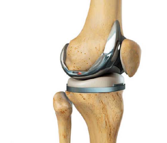 Hip and Knee Replacement Physiotherapy in Milton