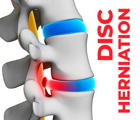 Disc Herniation Physiotherapy In Milton