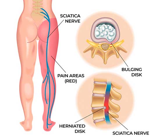 Sciatica Pain Physiotherapy in Milton