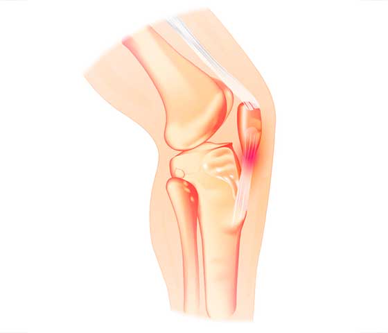 Jumper Knee Rehabilitation in Milton