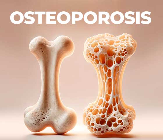 Osteoporosis Treatment in Milton