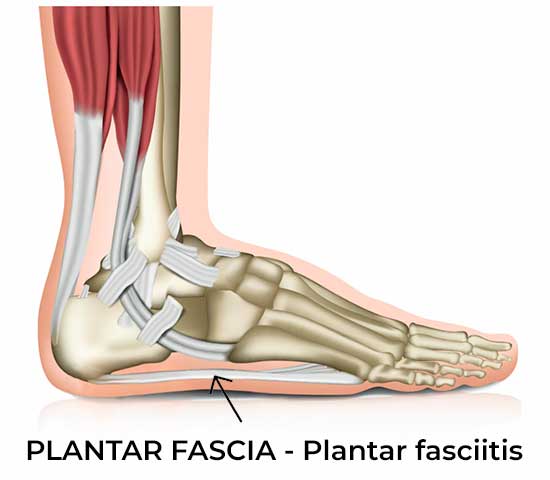 Foot Pain Plantar Fasciitis