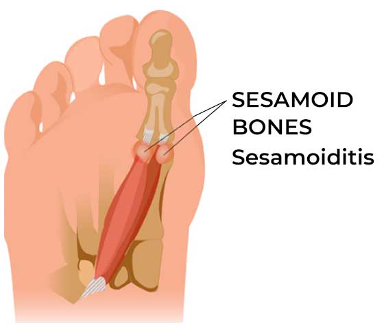 Foot Pain Sesamoiditis