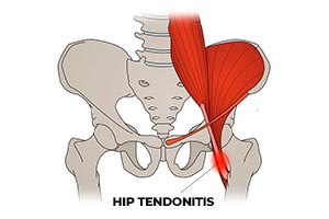 Hip Pain Treatment in Milton