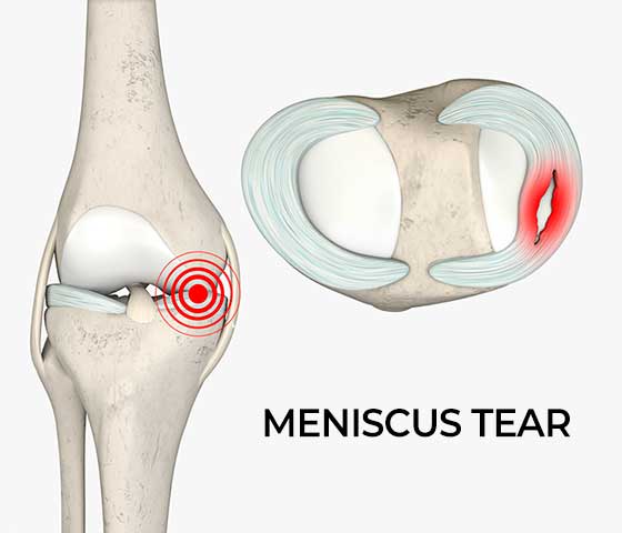 Knee Meniscus Tear Recovery in Milton