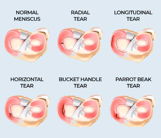 Knee Meniscus Tear Recovery in Milton