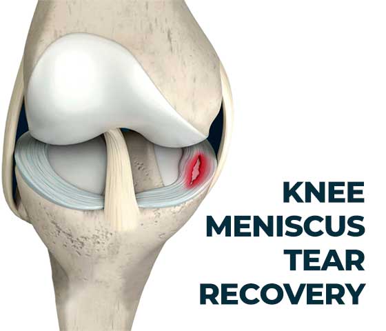 Knee Meniscus Tear Recovery in Milton