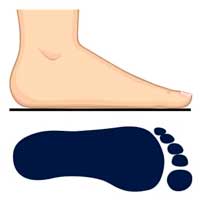 Flat Feet