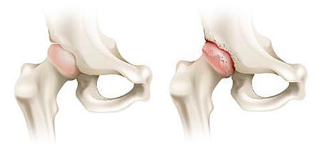 Hip Arthritis Treatment in Milton