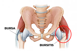 Hip Bursitis Treatment in Milton