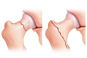 Hip Fracture Pain