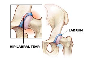 Hip labral tear Treatment in Milton