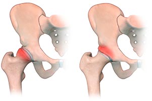 Hip Pincer Impingement Treatment in Milton