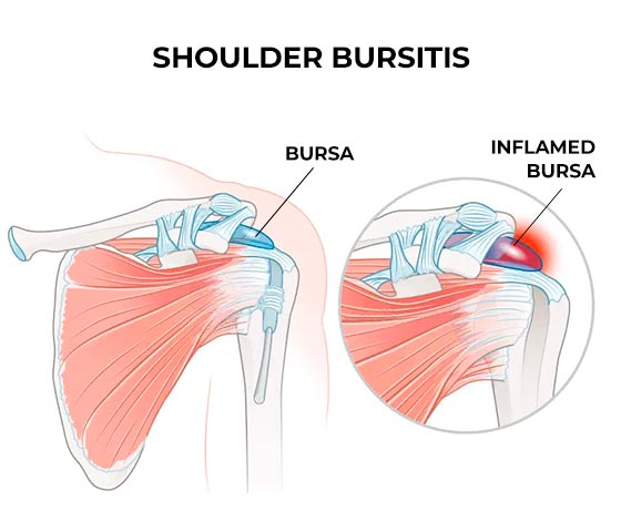 Bursitis Physiotherapy in Milton