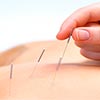 Dry Needling