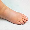 Lymphedema